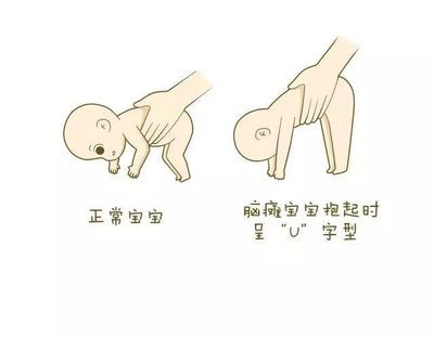 孩子患脑瘫和智力低下的区别到底是什么呢