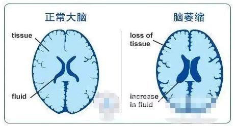 患脑萎缩的常见临床表现有什么
