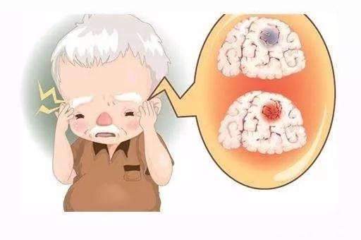 经颅磁刺激应用领域_怎么治疗和护理脑出血的人呢 