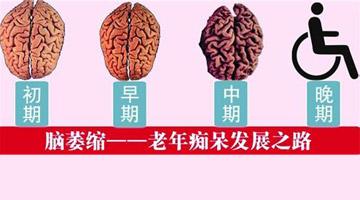 择思达斯经颅磁_脑萎缩会发展到什么程度了
