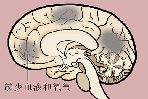 一台经颅磁刺激仪多少钱?早期的脑梗塞有什么特点 