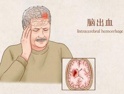 经颅磁刺激仪能要多少钱?脑出血的症状严重会怎样