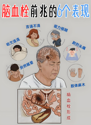 择思达斯经颅磁体验室_脑血栓的康复治疗方法